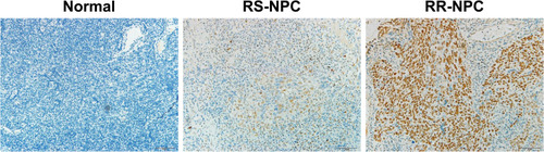 Figure 3 Differences of PSPC1 expression among the normal tissues, radiosensitive NPC tissues and radioresistant NPC tissues.