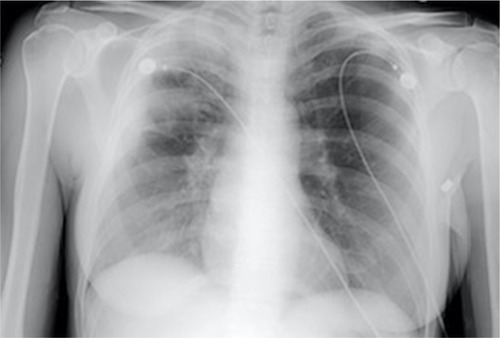 Figure 1 Chest X ray of a patient with CEP demonstrating peripheral opacities.