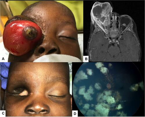 Figure 3 Bilateral Retinoblastoma with orbital invasion of the right eye (A). Magnetic resonance imaging revealing the orbital invasion and an intraocular lesion in the left eye (B). Partial exenteration was performed (C), followed by systemic chemotherapy and transpupillary thermotherapy of the left eye (D).