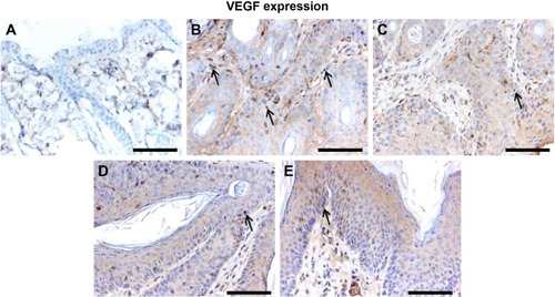 Figure 8 Effect of Leiurus quinquestriatus venom extract on VEGF expression in chemically induced skin tumors.