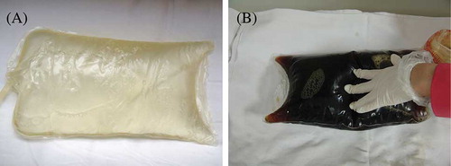 Figure 1. Peritoneal dialysate. (A) clear dialysate. (B) Cola-colored (brownish-black) peritoneal effluent.