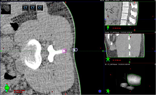 Figure 7 Measurement of lumbar spine registration error on 3D CT. The displacement values between the real L3↑ (purple circle) and the virtual L3↑ registration marker (white circle) in the AP and SI directions of the bed were considered the registration error.