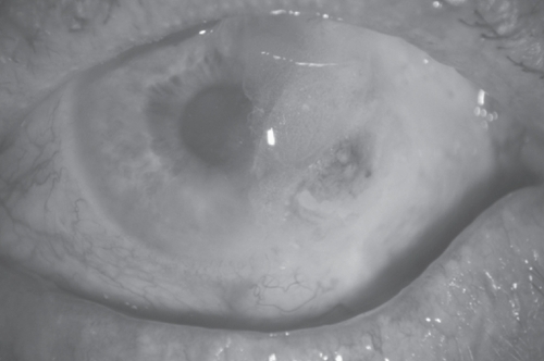 Figure 2 Large persistent conjunctival defect post corneal gluing.