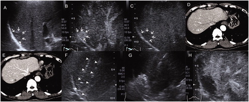 Figure 2. Images in a 60-year-old man received radiofrequency ablation (RFA) for a recurrent hepatocellular carcinoma (r-HCC) in the transplanted liver. A, Pre-interventional B-mode ultrasound showed a tumor sized 1.5 cm × 1.4 cm (arrow). B and C, Contrast-enhanced ultrasound (CEUS) before RFA showed obvious enhancement in the artery phase (B) and washout in the late phase (C) (arrow). D and E, Contrast-enhanced computed tomography (CECT) before RFA showed obvious enhancement in the artery phase (D) and washout in the late phase (E) (arrow). F, Electrode placement during the ablation (arrowhead). G, Tumor appeared completely hyperechoic after the beginning of RFA. H, CEUS obtained 1 month after RFA showed no contrast enhancement, suggesting complete ablation.