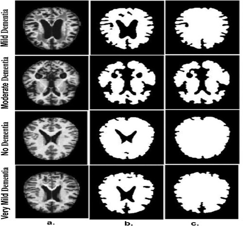 Figure 4. A few MRI samples for all classes of an Alzheimer’s data set a. Original image b. After the segmentation process c. After the morphology process.