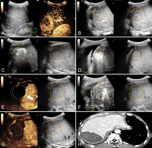Figure 1 A 50-year-old man had a 5.1 cm MLC lesion pathologically confirmed as gastric cancer. (A) CEUS showed a large-sized MLC nodule (51 × 47 mm) in segment VI/VII. (B) after extraction and storage of the 3D ultrasound volume image in the volume navigation system, the target MLC nodule (yellow) and its 5mm-AM (red) were outlined on 3DUS-US FI. (C and D) The target MLC nodules were ablated with two electrodes based on 3DUS-US FI guidance, particularly when the nodules became nonobvious after ablation. (E) After 12 ablation cycles, partial perfusion was observed within the nodules on 3DUS-CEUS FI (arrow). (F) Three immediate supplementary ablations were performed under 3DUS-US FI guidance. (G) 3DUS-CEUS FI was evaluated again and the non-perfusion area on the CEUS covered the entire target MLC nodule and its 5mm-AM. (H) One month later, contrast-enhanced CT confirmed the results of complete ablation.