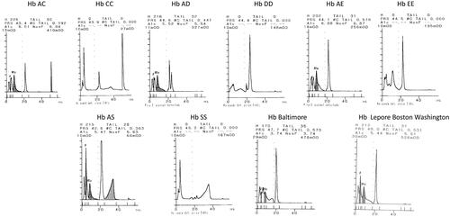 Figure 5. Chromatograms of Hb variants.