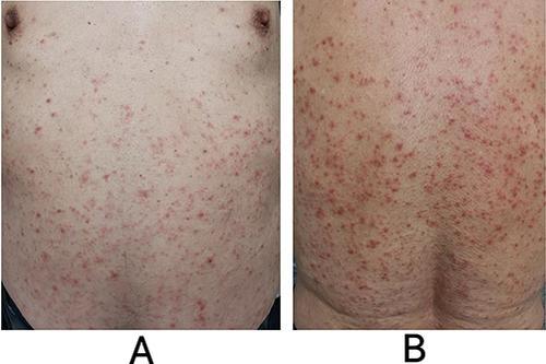 Figure 1 (A and B) palpable erythema and papules on his trunk.