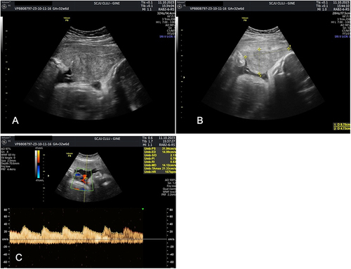 Figure 3 (A and B) Retroplacental hematoma (C) Normal umbilical artery Doppler parameters.
