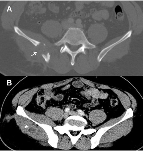Figure 1 Transverse computed tomography image of the pelvis.