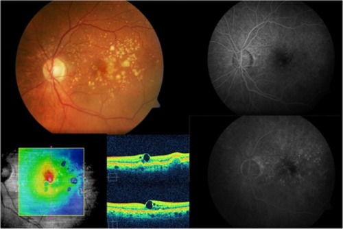 Figure 5 Cirrus™ optical coherence tomography scan.