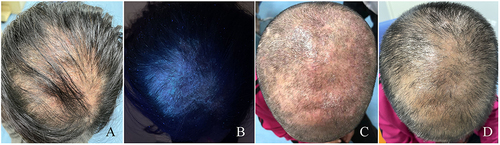 Figure 1 The clinical manifestations of the patient. (A) image showing the seborrheic dermatitis-like rash and hair loss on the scalp of patients with initially diagnosed tinea capitis. (B) image showing the lesions represents the same field as A under the Wood lamp. (C and D) images showing the lesions on the scalp of patients with tinea capitis before and after treatment.