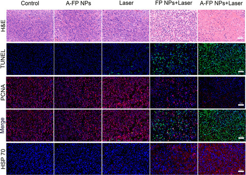 Figure 12 HE, TUNEL, PCNA and HSP70 staining of the tumor tissue at 1 day after various treatments. From top to bottom: HE-stained cells, TUNEL-positive cells (green), PCNA-positive cells (red), TUNEL and PCNA merge, HSP70-positive cells (red). The DAPI-labeled nuclei is blue. The scale bars are 50 μm.Abbreviations: HE, hematoxylin and eosin staining; TUNEL, terminal deoxynucleotidyl transferase dUTP nick end labeling; PCNA, proliferating cell nuclear antigen; HSP70, Heat shock 70 kDa protein; DAPI, 4,6-diamidino-2-phenylindole; A-FP NPs, AS1411-PLGA@FePc@PFP; FP NPs, PLGA@FePc@PFP.