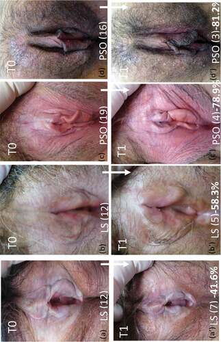 Figure 2. Illustrative photos of patients with lichen sclerosus (LS) and psoriasis, at time 0 (T0) and time 1 (T1). a, b: LS at T0; c, d: psoriasis at T0; a’, b’: LS at T1; c’, d’: psoriasis at T0. GCS (Global Clinical Score), a: 12, a’: 7 (−41.6%); b: 12, b’: 5 (−58.3%); c: 19, c’: 4 (−78.9%); d: 16, d’: 3 (−81.2%).