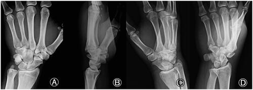 Figure 1. Isolated left trapezoid coronal shearing fracture in a 40-year-old male. (A) An X-ray of the wrist joint in the anterior-posterior view showing an irregular shape of the left trapezoid. (B) The lateral view in supination raised suspicion for a coronal shearing fracture of the trapezoid. (C) Oblique views recorded during pronation, showing no apparent findings. (D) The oblique view in supination clearly shows the fracture. No other carpal fractures are visible.