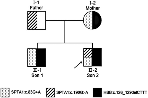 Figure 2. Pedigree of a Chinese family with hereditary spherocytosis and β-thalassemia trait. Black arrow, proband.