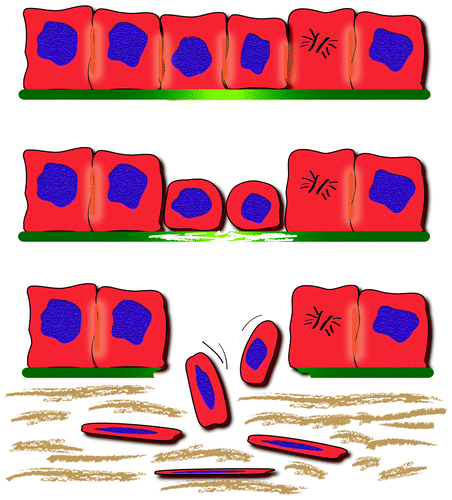 Figure 5. Sequential steps in epithelial-mesenchymal transition at the infiltrative margin of colon cancer. Some tumor cells detached from nearest cells acquire a spindle shape and infiltrate the surrounding tissues.