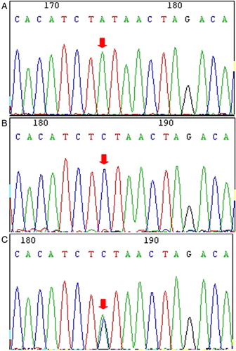 Figure 2. Polymorphism at position 13751 (rs661561) in the A20 gene. (A) T-ALL case with a wild-type sequence. (B) Homozygous A > C nucleotide exchange at position 13751 in a T-ALL case. (C) Heterozygous A > C nucleotide exchange at position 13751 in the Toledo cell line.