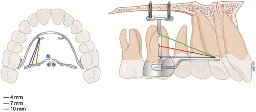 Figure 3. Notches in the MCPP lever arm.