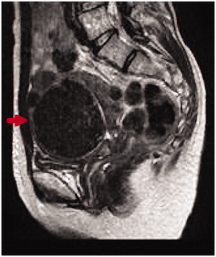 Figure 3. Pelvic MRI: On T2-weighted MRI, a low-intensity area with a maximum diameter of 80 mm and clear boundary is present on the anterior uterine wall. MRI, magnetic resonance imaging.
