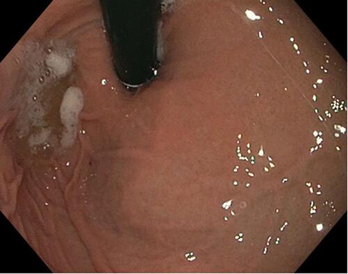 Figure 3 Image obtained during esophagogastroduodenoscopy. There was minimal residual gastric fluid which could not be aspirated into the suction canister.