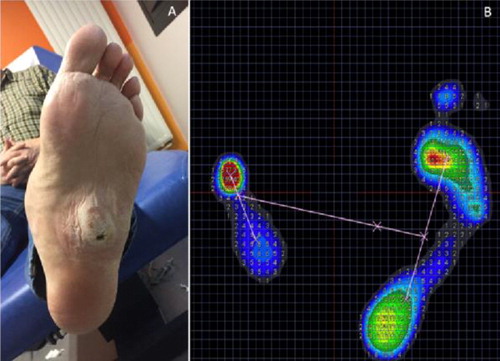 Figure 1. (A) Location of the pressure ulcer, (B) static plantar pressure up to 75 N/cm2.