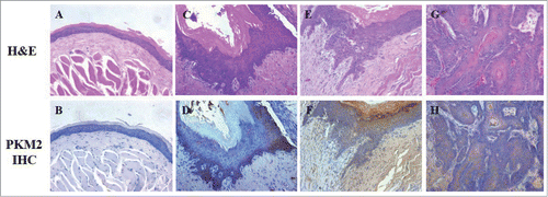 Figure 1. PKM2 expression in DMBA-induced OSCC animal model. (A and B) H&E and PKM2 immunohistochemical staining of normal buccal epithelial in control animals (×200); (C and D) H&E and PKM2 immunohistochemical staining of epithelial hyperplasia in experimental animals (×200); (E and F) H&E and PKM2 immunohistochemical staining of epithelial dysplasia/carcinoma in situ in experimental animals (×200); (G and H) H&E and PKM2 immunohistochemical staining of squamous cell carcinoma in experimental animals (×200).