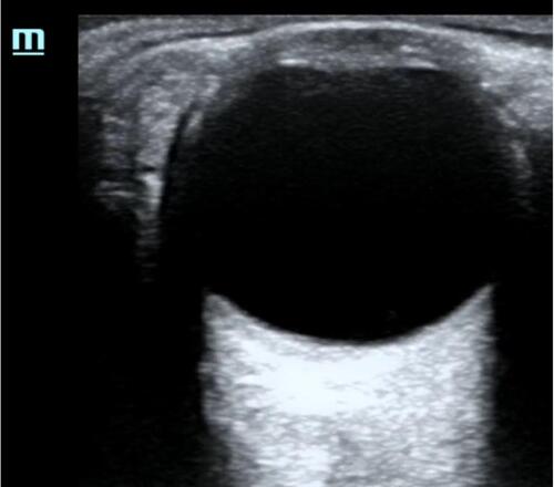 Figure 1 Point of care ultrasound image of normal eye.
