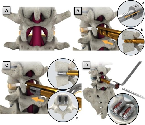 Figure 2 Posterior lumbar interbody fusion procedure highlights: (A) implant site preparation; (B) sizing; (a) depth collar allows controlled depth of sizing instrument; (b) magnified cross-section view of PLIF sizing instrument; (C) implant insertion and expansion; (a) lateral cross-section; (b) axial cross-section; and (D) bone graft placement, with magnified-oblique view of the expanded cages packed with bone graft (inset). Arrows indicate insertion directions.