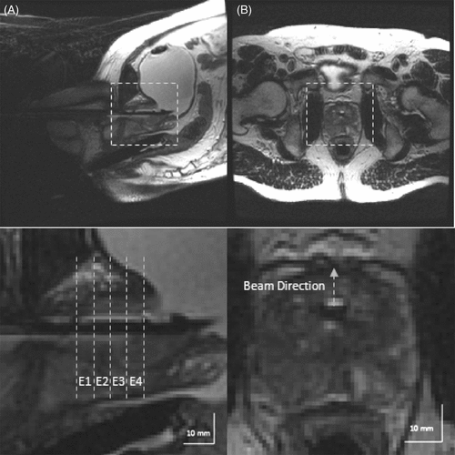 Figure 2. (A) T2-weighted images acquired along the length of the ultrasound applicator show the location of the transducers relative to the prostate gland. Based on these measurements, the device can be advanced or retracted to the desired position within the prostate gland. (B) The angular orientation of the ultrasound applicator is determined by acquiring a T2-weighted image transverse to the device to visualize the flat face of the transducer.