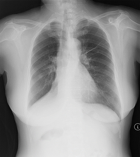 Figure 1 Chest radiograph. Atelectasis is indicated by the covered right heart margin, the declivitous right lower lobe bronchus, and the triangular high-density shadow above the right diaphragm covering the right diaphragm and right lower lobe blood vessel. There is a fiber chord in the left lung.