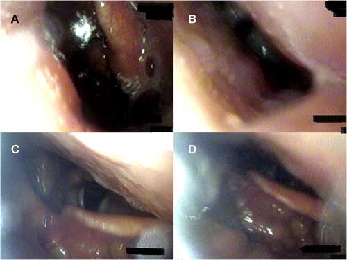 Figure 7 Drug-induced sleep endoscopy results at the tongue base level: head rotation to the left. Head rotation without intermittent negative airway pressure (iNAP) therapy during (A) inspiration and (B) expiration. Head rotation with iNAP therapy during (C) inspiration and (D) expiration.