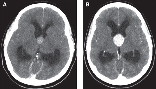 Figure 1. A: CT scan of Sister A, carried out when she went to the emergency room. There is a contrast-enhancing lesion in the third ventricle in the region of foramen Monroi. Also, there is a pronounced obstructive hydrocephalus with dilatation of the lateral ventricles. 201 × 201 mm (72 × 72 DPI). B: CT scan of Sister B, carried out when we got to know that she was under investigation for severe headache attacks. As in her twin sister, there is a contrast-enhancing lesion in the third ventricle in the region of foramen Monroi. There is a pronounced obstructive hydrocephalus with dilatation of the lateral ventricles as well. 201 × 201 mm (72 × 72 DPI).