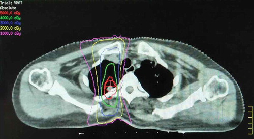 Figure 2. Registration of CT/simulation to target paraspinal lesion.It shows the CT simulation image for radiotherapy planning. The right paraspinal lesion was selected as the irradiated target. The treatment plan was designed with 6 MV photons by means of a coplanar two-field VMAT. The isodose lines represent total doses of 50 Gy (red), 40 Gy (green), 30 Gy (blue), and 10 Gy (pink).