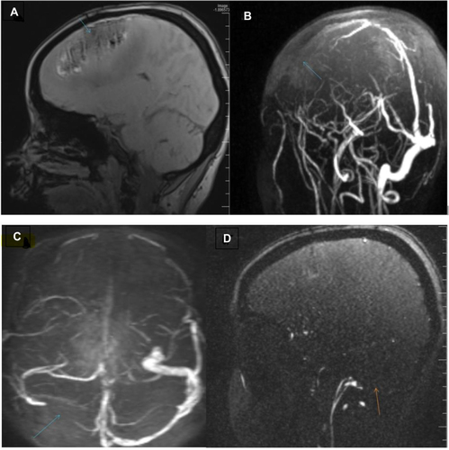 Figure 2 (A and B) MR venogram showing large filling defects area in the anterior aspect of the superior sagittal sinus representing thrombosis and associated right frontoparietal lobes cortical-subcortical areas heterogenous lesion corresponding venous hemorrhagic infarct (green arrow). (C and D) MR venogram (TOF) Shows filling defect in the right transverse sinus indicating thrombosis (green and Orange arrows).