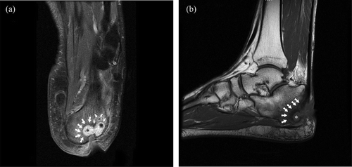 Figure 1. The planned resection level (white arrows) of the osteomyelitis on sagittal (a) and coronal (b) magnetic resonance imaging sections covering the abscess (asterisks). Actual resection can be predicted by including a few millimeters of bone covering the hypointense area over the nidus.