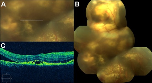 Figure 62 Coats’ disease.