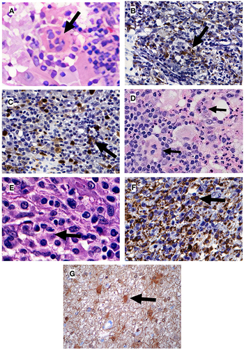 Figure 1 Histopathological findings for patients 1 and 2. (A) Patient 1. Non-neoplastic proliferation showing lymphocyte emperipolesis on 800x increase; (B) Patient 1. Positive immunohistochemistry for CD68 (indicating macrophages) on histiocytic infiltrate; (C) Patient 1. Immunohistochemistry with occasional positivity for S100 on histiocytic infiltrate; (D) Patient 2. Non-neoplastic proliferation showing lymphocyte emperipolesis on 400x increase; (E) Patient 2. Non-neoplastic proliferation showing lymphocyte emperipolesis on 800x increase; (F) Patient 2. Positive immunohistochemistry for CD68 (indicating macrophages) on histiocytic infiltrate; (G) Patient 2. Positive immunohistochemistry for S100; Black arrows indicate emperipolesis on (A, D and E), and indicate immunohistochemistry positivity on (B, C, F and G).