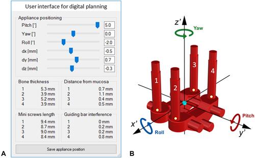 Figure 6 (A) User interface developed with Rhinoceros software, with which the inclination (Yaw, Pitch, and Roll) and position (dx, dy, dz) of MSE appliance can be changed to optimize the bone thickness (BT) at the level of the 4 micro-implants identified with numbers 1–4, the appliance distance from the palatal mucosa (DM), the micro-implant length required to obtain bicortical engagement (ML) and the guiding bar interference (GBI). (B) yaw, pitch, roll, and reference axes for MSE.