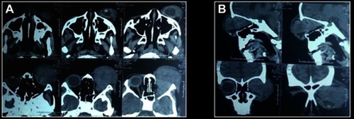 Figure 2 (A) Multi slice computed tomography (MSCT) scan of the orbit clearly shows right eye proptosis with lesion involving superior orbit, lateral orbit and retro bulbar space; (B) The lesion had variegated appearances and was indenting the globe.