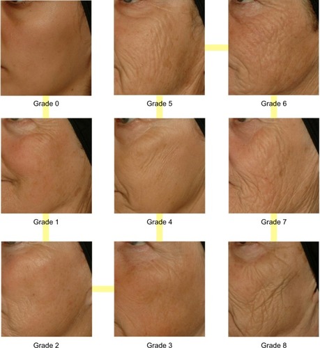Figure 2 Clinical standardized photographic scale of cheek folds.