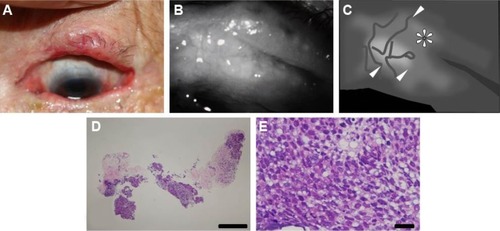 Figure 6 Case 8: an 82-year-old woman with recurrent sebaceous carcinoma.