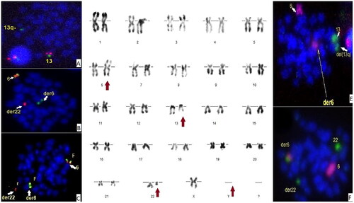 Figure 2. panel A: D-FISH 13q14.2(red)/13q34(Green). panel B: Break apart FISH 5’IRF4(red)/3’IRF4(green). panel C: Break apart FISH 5’-IGL(red)/3’IGL(green). panel D: R-banding karyotype. panel E: Whole chromosome painting FISH chromosome 6 (red) and chromosome 13 (Green). panel F: Whole chromosome painting FISH chromosome 6 (red) and chromosome 22 (Green).
