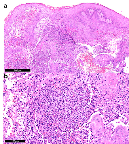 Figure 2 Histological HE staining photographs. (a) magnified 5 times, and (b) magnified 20 times.