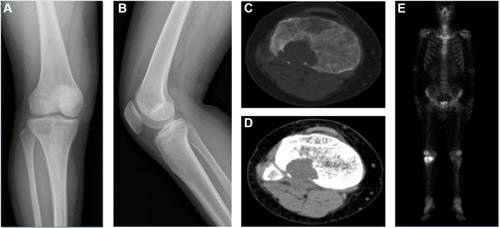 Figure 1 Radiological images of the proximal right tibia. Radiograph (A and B) and CT (C and D) showed osteolytic bony destruction. SPECT (E) images were negative for metastatic lesions.