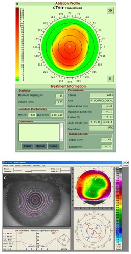 Figure 3 (A) Right eye videokeratographic map in a 34-year-old female patient before treatment. The topographic pattern highlights irregular astigmatism (relative scale, tangential algorithm). (B) Pattern of transepithelial customized ablation. (C) Right eye videokeratographic map 2 years after customized photorefractive keratectomy and corneal collagen cross-linking with riboflavin and ultraviolet A irradiation. The topographic pattern showed an improvement in the corneal profile, with central flattening (relative scale, tangential algorithm).