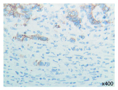 Figure 3. E-cadherin immunoreactivity: fragmentation of the membranous staining of tumor cells with features of epithelial-mesenchymal transition. OMx400.