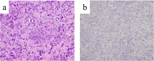 Figure 2 Histopathological findings of biopsied primary gastric cancer. (a) On hematoxylin and eosin staining, alveolar and solid proliferation of tumor cells with hyperchromatic and enlarged nuclei with occasional glandular lumina were detected. (b) On immunostaining, the tumor cells were negative for HER2.