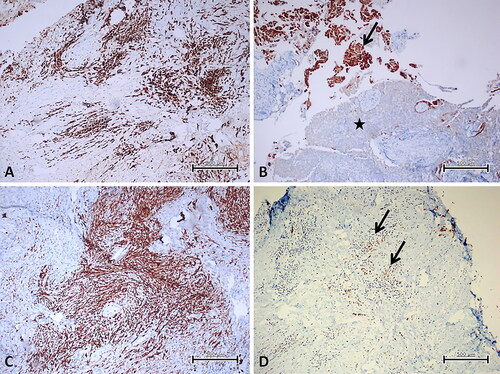 Figure 2. VISTA and PD-L1 expression levels in malignant mesothelioma subtypes. (A) Strong membranous VISTA expression in epithelioid mesothelioma (immunoperoxidase, 100X). (B) Biphasic mesothelioma: Strong VISTA expression (arrow) in epithelioid areas, VISTA negative (star) in sarcomatoid areas (immunoperoxidase; 100X) C. Strong membranous PD-L1 positivity in sarcomatoid mesothelioma (immunoperoxidase, 100X). (D) Focal, weak PD-L1 positivity (arrow) in biphasic mesothelioma (immunoperoxidase, 100X). Scale bar = 500 µm.