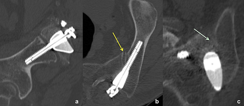 Figure 11 The 12-month follow-up CT scan shows (a) solid fusion with the porous portions of the implant body, (b, yellow arrow) absence of the preoperative vacuum phenomenon in the distracted SIJ, (c, green arrow) a bony bridged recess, and no lucency around the (a and b) iliac or (c) sacral screws.